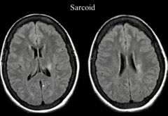 Sarcoid
May Confuse This Case With MS