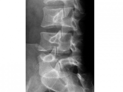A 17-year-old high school football lineman was diagnosed with the condition shown in the Figure A radiograph. He continues to have pain despite 6 months of wearing a custom lumbar spine orthotic (LSO) and avoiding all sports activities. His physic...