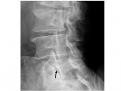 his clinical presentation is consistent with a symptomatic spondylolysis, without listhesis or neurologic deficits, that has failed nonoperative management. Pain with single-limb standing lumbar extension is a characteristic physical finding with ...