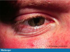 Allergic Shiners - darkening under the eyes from chronic deposition of hemosiderin in tissues

Dennie Morgan lines - fine horizontal lines in the lower lids; occur through spasms of Mueller's muscles in the lids