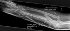 A Monteggia fracture with apex anterior ulnar shaft fracture is associated with an anterior radial head dislocation (See Illustration A). 

ans4