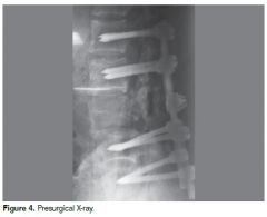 2-indications Tx & Rehab/Time
2.1-Pedi asymptomatic pts with low-grade spondylolithesis or spondylolysis 
2.2-Pedi sx isthmic spondylolysis
symptomatic low grade spondylolithesis
2.3Pedi- acute pars stress reaction spondylolysis
isthmic spond...