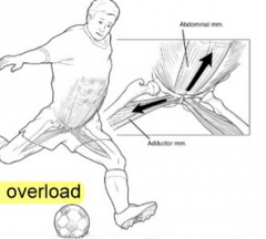 -sportsman's groin
-repetitive mircotrauma, training overload
-add tendonitis, pubic bone edema/stress reaction/periostitis pubis
-+ve squeeze test
-XR, bone scan, MRI
-1. lumbopelvic and hip stabiliser motor control - decrease hip F/IR 
2. ...