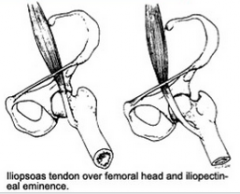 -iliopsoas "snaps" over the iliopectineal eminence
-young females
-repetitive hip F
-deep clunk when bringing hip from F to E - noise can be modified if put pressure over the tendon
-improving hip extension, length of iliopsoas, hip rot strength