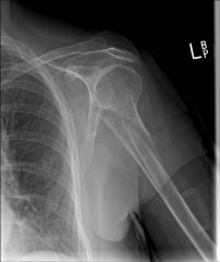  Figure A is a radiograph of an 80-year-old woman who sustained a closed injury to her left arm 10 months ago. She presents to office today complaining of persistent pain in her arm. What is the most likely metabolic or endocrine abnormality cont...