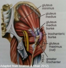 -tendinopathies of the gluteal tendons and bursa
-lateral hip area:
glut med/min tendinophy
glut med/min tears
trochanteric bursitis
-lower neck shaft angle 
-lateral pain on palpation, no difficulty in putting on shoes, reproduction of pain...