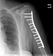 oligotrophic nonunion of a proximal third humeral shaft fracture. The most likely underlying metabolic or endocrine abnormality with this presentation is vitamin D deficiency. Predisposing factors include: mechanical instability, poor bone-to-bon...