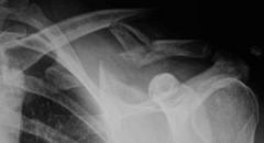 A 22-year-old male sustains the injury shown in Figures A and B as the result of a fall from a ladder. Which of the following has been shown to be true regarding operative versus nonoperative treatment of this injury?


1.  Decreased chance of...
