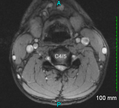 A 33-year-old male presents with neck and left arm pain. He denies symptoms in his right arm. Based on the MRI image shown in Fig A, what findings would be expected on physical exam? 
1.  weakness to shoulder shrug
2.  weakness to shoulder ab...