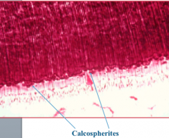calcospherites

solid mass of mineralized (globular) dentin

inter-globular dentin
