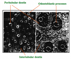 Odontoblastic processes are within dentinal tubules