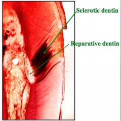 Sclerotic dentin
-can sometimes be repaired with reparative dentin

Dead dentinal tract