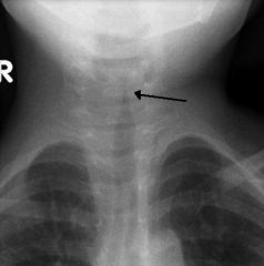 Most common cause of CROUP (laryngotracheobronchitis) in infants

causes INSPIRATORY STRIDOR (upper airway obstruction) d/t submucosal edema in trachea

Anterior of neck shows "STEEPLE SIGN" representing mucosal edema in the trachea (site of o...