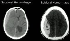 subdural --> convex & compresses ventricles & chronic


epidural --> concave & middle menigeal artery & acute