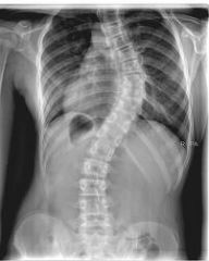 Which of the following statements regarding osteoid osteomas in the spine is correct?  
1.  Scoliosis caused by osteoid osteoma is typically a flexible curve 
2.  Osteoid osteomas in the spine cannot be treated by radiofrequency ablation 
3.  S...