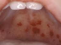 -Causes fever, cough, conjunctivitis, and excessive nasal mucus production

-patients usually have KOPLIK spots which precedes onset of rash

-presence of Warthin-Finkeldey multinucleated
