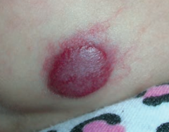 What are the characteristics of a Strawberry Hemangioma?