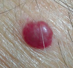 What are the characteristics of a Cherry Hemangioma?