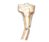 An incomplete break in an immature bone – usually a result of bending force