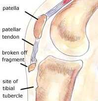A ligament or tendon tears a small piece of bone away from its cortex - usually as a result of a powerful twist or stretch of a body part