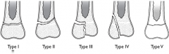 Type I – Separation, Type II – Fracture – separation, Type III – Fracture-part of physis, Type IV –Fracture-epiphysis and physeal plate, Type V – Crushing of the epiphyseal plate *All can cause premature closure*