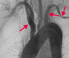 Takayasu arteritis - large vessel vasculitis
- Granulomatous thickening and narrowing of aortic arch and proximal great vessels
- ↑ ESR
- Treat with corticosteroids
