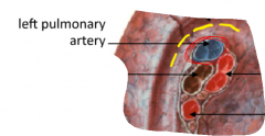 in the Left lung, the pulmonary artery always sits in the most superior position. (right lung is more central and lower. 