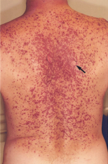 Reaction to life-threatening adverse cutaneous drug reaction