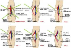 1-Popliteal Artery Entrapment Syndrome=A condition characterized by constriction of the popliteal artery by either adjacent muscles, tendons, fibrous tissues
Type II	Medial head of the gastrocnemius is located laterally, no deviation of popliteal...