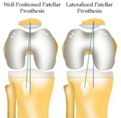 Lateralization of the femoral prosthesis would not lead to lateral patellar subluxation. However, lateralization of the patella or the tibial tray could lead to lateral patellar subluxation. Medialization, not lateralization of the femoral prosthe...