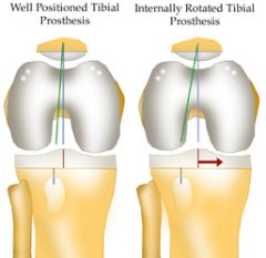 1-MCC TKA=Abnormal patellar tracking
-MIV=preservation->nl Q ang
2-abn Q=inc latel subluxation forces on the patella
poss pain, mech sx, accelerated wear, even dislocation.
3-***avoid (4)- Injurious IR fem, IE tib, med of fem, lat of patella
...