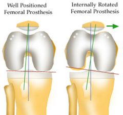 The posterior condylar axis may be used to determine the rotation of the femoral component in total knee arthroplasty. Which of the following describes the normal relation of the posterior condylar axis?  
1.  Parallel to the transepicondylar axi...
