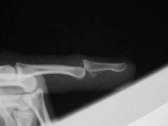 1-common injuries seen with phalanx dislocation? (2)
-must get xray of___?
2-PIP dislocations MC in what direction? If this injury what MCC? if dorsal dislocation what may acts as block to reduction with longitudinal traction?
3-classif of PIP ...