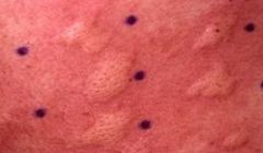 










Firm, edematous plaque resulting
from

 infiltration of the dermis with fluid

Transient and last hours
