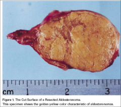 Aldosteronoma. A possible cause of metabolic alkalosis due to xs aldosterone.