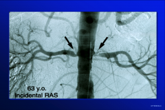 *Bilateral renal artery stenosis. A possible cause of metabolic alkalosis due to xs aldosterone.