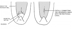 Incomplete fusion near the leading edge of the urorectal septum (bifid). 

Can cause the urogenital and rectoanal canals to maintain a connection.