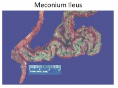 If the meconium is too viscous, the newborn may not be able to pass it and so it becomes a source of obstruction.