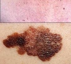 malignant melanoma 
(Asymmetry,
borders,
color variations,
diameter)