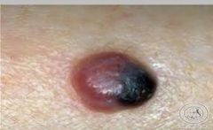 










¤Dome-shaped
or pedunculated 
 ¤Dark
red brown-black







which type of melanoma?