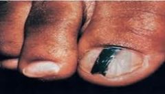 










¤Palms,
soles, terminal phalanges and mucous membranes 
 ¤MC in
AA and Asians 
 ¤Elevated
lesions are associated with deeper invasion 