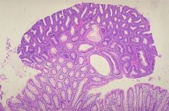 Overgrowth of glands

The nuclei are nicely organized – not a dysplastic cancer

Precancerous tubularadenoma
