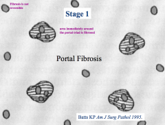 Portal Fibrosis:
- Area immediately surrounding the portal triad is fibrosed
