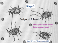 Periportal Fibrosis:
- Extent of scarring is extending beyond the portal triad area
- Spider-like appendages extend from one portal triad to another