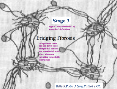 Bridging Fibrosis:
- Collagen scar tissue has laid down bridges that connect one portal triad to the others
- Minimal fibrosis towards the central veins