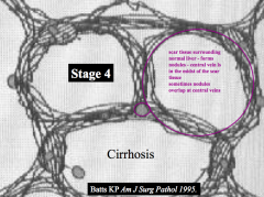 Stage 4 - Cirrhosis
- Presence of nodules