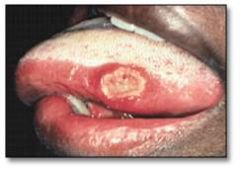 (long term ulcer)
see below for differential diagnoses
PRACTICE TEST: (determine your differential list in the allotted time and modify your
differential list based on the "patient" history)
1) GIVE 8 DIFFERENTIALS IN 2 MINUTES (NEGATIVE FOR FUNGAL IN
