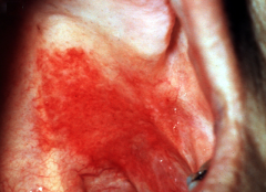 (please focus on the most obvious and largest lesion)
DDx