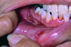 Patient also has multiple bullae in the contralateral vestibule. Lesions in right vestibule, left vestibule (not shown) and lip mucosa are related.
DDx