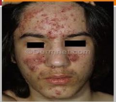 

Severe inflammatory response to P. acnes infection